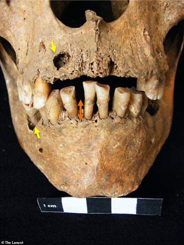 Although archaeologists did not know that the remains were riddled with disease, the skull features marks such as larger-than-average teeth and a serious gum infection that damaged the soft tissues in his mouth before death.
